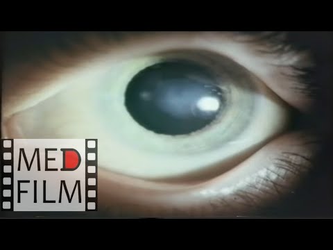 Видео: Патология глаз при болезнях у детей © Pathology in diseases of the eye in children