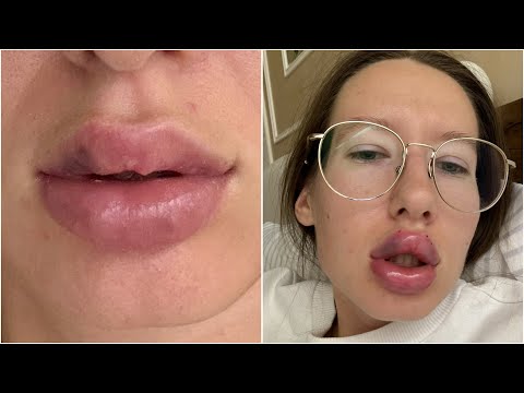 Видео: НЕУДАЧНО УВЕЛИЧИЛА ГУБЫ? | я пережила это........