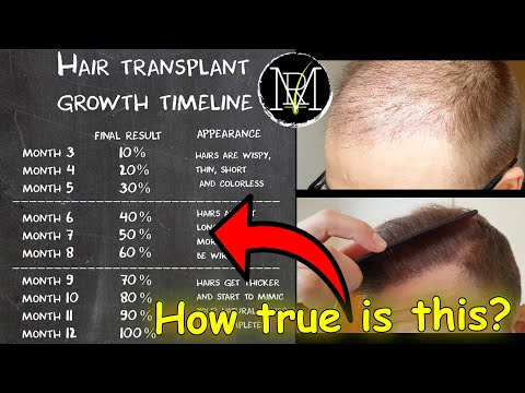 Видео: Хронология роста волос после пересадки | Месяцы 1–9 | Норвуд 5