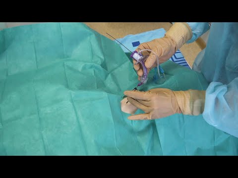 Видео: Пункционная коникотомия с проводником