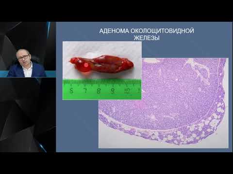 Видео: Профессор Слепцов И. В. :   Диагностика и лечение первичного гиперпаратиреоза