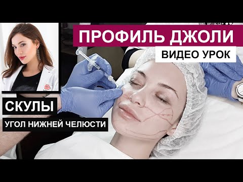 Видео: Профиль Джоли - скулы, угол нижней челюсти / контурная пластика