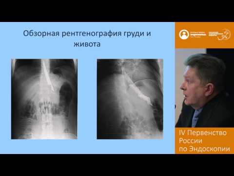 Видео: Опасное инородное тело пищевода и желудка