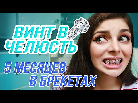 Видео: ПОЛГОДА В БРЕКЕТАХ / Винт в челюсть!