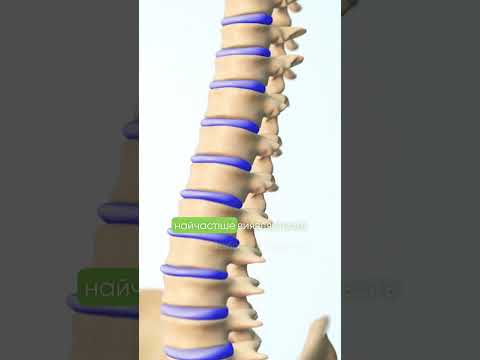 Видео: Види сколіозу