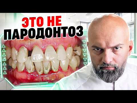 Видео: 🔴 СТОМАТОЛОГИ ВРУТ? Пародонтоз НЕ СУЩЕСТВУЕТ! Твои зубы в опасности!