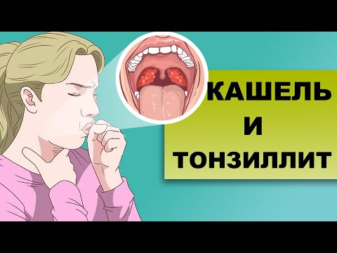 Видео: ТОНЗИЛИТНЫЙ КАШЕЛЬ. Кашель при хроническом тонзиллите