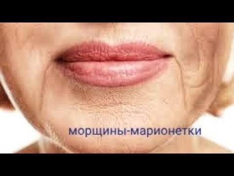 Видео: МОРЩИНЫ МАРИОНЕТКИ. Опущенные уголки губ.