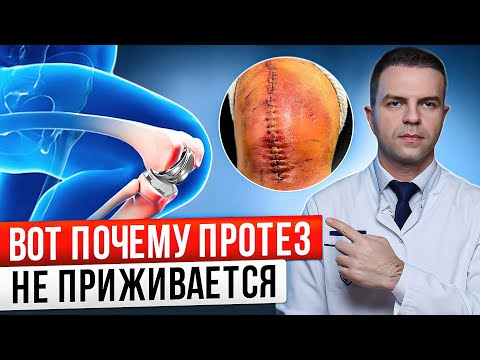 Видео: Самая частая причина того, что эндопротез не приживается! Что делать при асептическом расшатывании?