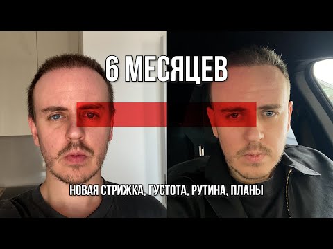 Видео: 6 Месяцев после второй пересадки волос