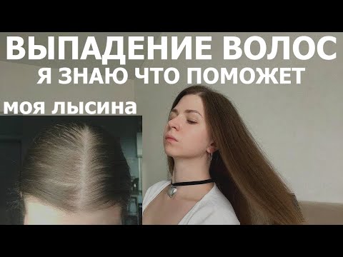 Видео: ВЫПАДЕНИЕ ВОЛОС | Я ЗНАЮ ЧТО ПОМОЖЕТ | У МЕНЯ АНДРОГЕННАЯ АЛОПЕЦИЯ 10 ЛЕТ #алопеция #алерана