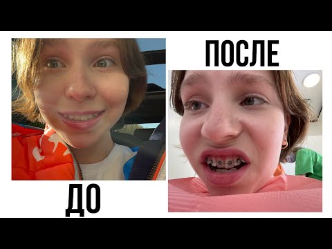 Видео: МНЕ ПОСТАВИЛИ БРЕКЕТЫ!!! ***мои ощущения + влог***
