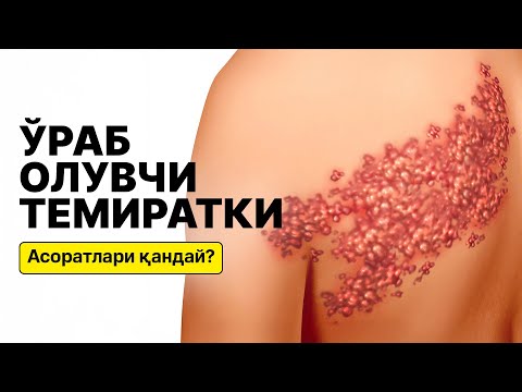 Видео: Ўраб олувчи темиратки асоратлари ва уларни олдини олиш | 78 555 77 17