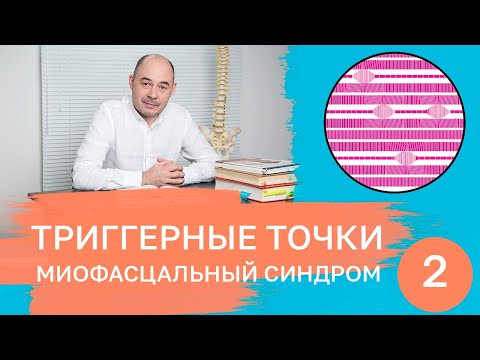 Видео: Триггерные точки. Миофасциальный синдром.