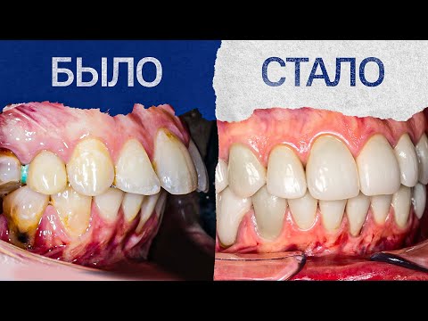 Видео: В то, что эти зубы получилось исправить — НЕвозможно поверить!