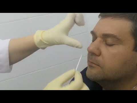 Видео: Анемизация носа в Екатеринбурге