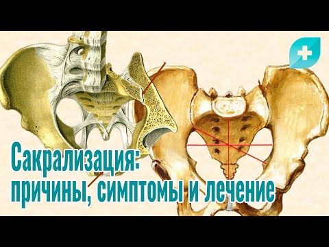 Видео: Сакрализация: причины, симптомы и лечение