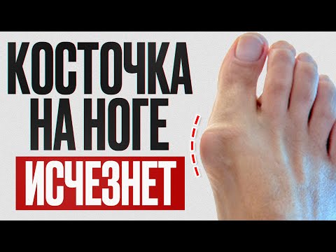 Видео: Шишка на большом пальце уйдет НАВСЕГДА! / Упражнения и рекомендации для устранения «косточки»