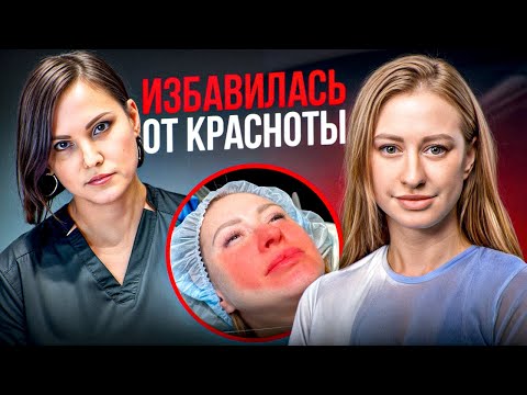 Видео: Лучший способ избавиться от красноты лица. Лечим розацеа лазером
