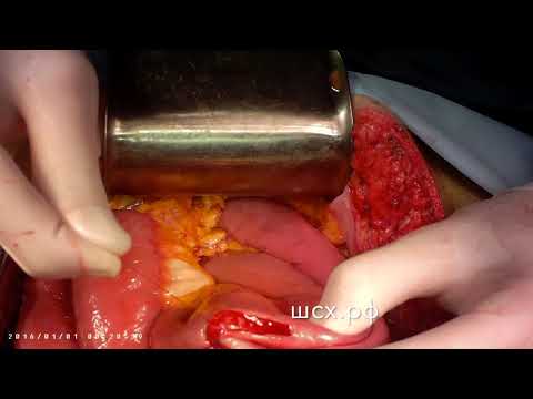 Видео: Энтеро-энтероанастомоз бок в бок