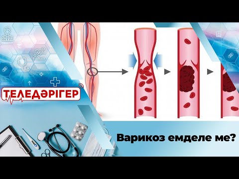 Видео: Варикоз емделе ме? І «Теледәрігер»