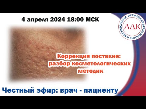 Видео: Коррекция постакне: разбор косметологических методик