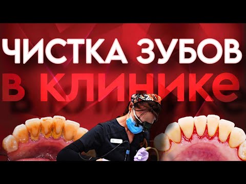 Видео: Профессиональная чистка зубов со мной