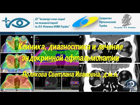 Видео: Клиника, диагностика и лечение эндокринной офтальмопатии