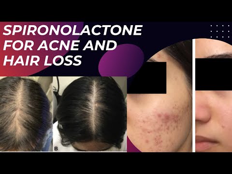 Видео: Спиронолактон от акне и выпадения волос — объясняет дерматолог