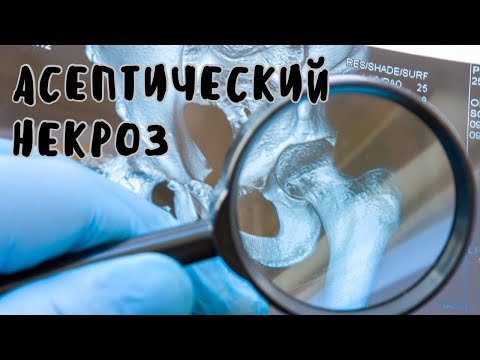 Видео: Асептический некроз | лечение и реабилитация
