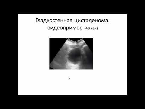 Видео: УЗИ опухолей яичников.Видеолекция