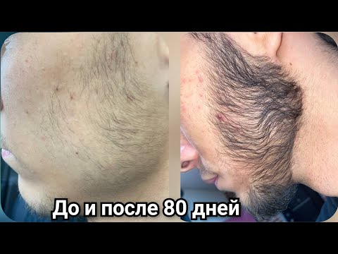 Видео: Начал использовать Миноксидил на бороду. Что стало со мной за 80 дней? Выпуск 89 Андрей Борода