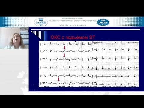 Видео: Бакалец Н.Ф. Острый коронарный синдром 6 курс