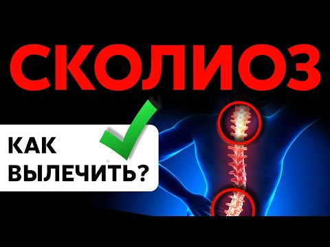 Видео: Как вылечить СКОЛИОЗ?