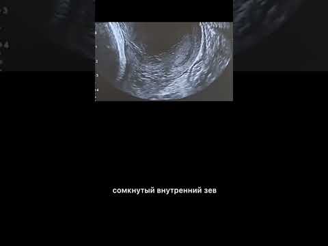 Видео: #узи #цервикометрия