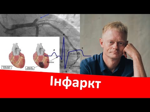 Видео: Інфаркт