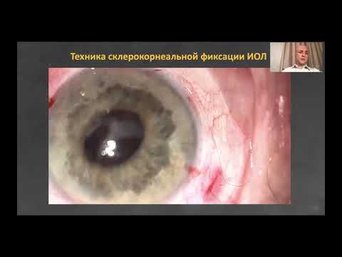 Видео: Секция "Современные технологии хирургии катаракты.  Новые ИОЛ"