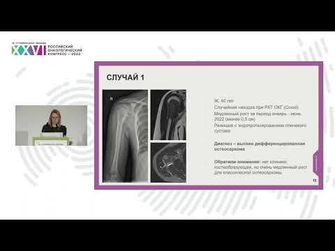Видео: Редкие подтипы сарком – трудности интерпретации, особенности диагностики