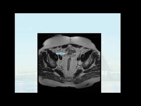 Видео: Доклад: «МРТ в диагностике локорегионарных рецидивов рака прямой кишки»