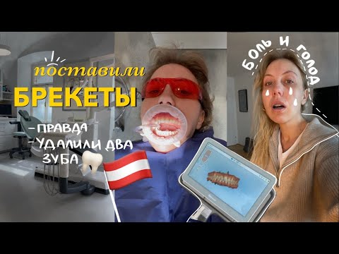 Видео: Брекеты в Австрии установка и удаление зубов мудрости боль