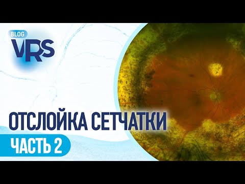 Видео: Отслойка сетчатки / часть 2