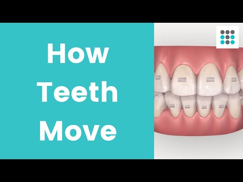 Видео: КАК ЗУБЫ ПЕРЕМЕЩАЮТСЯ С ПОМОЩЬЮ ЭЛАЙНЕРОВ И БРЕКЕТОВ. Доктор Мелисса Бейли, ортодонт