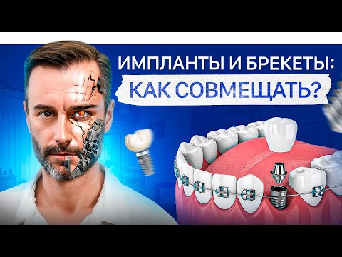 Видео: Можно ли ставить имплантаты пока носишь брекеты? ИМПЛАНТЫ + БРЕКЕТЫ
