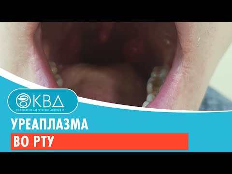 Видео: 👅 Уреаплазма во рту. Клинический случай №297