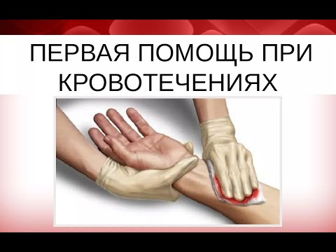 Видео: Первая помощь при острой кровопотере