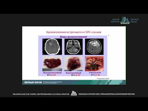 Видео: Какие проблемы при лечении больных с местатическим поражением головного мозга? Взгляд нейрохирурга