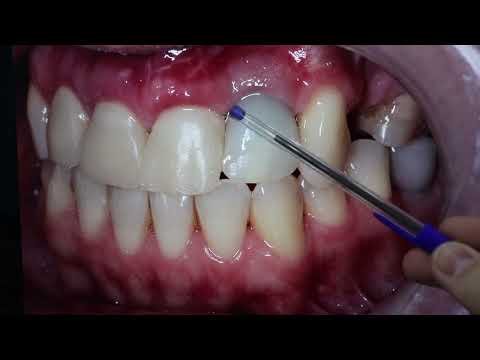 Видео: Стомбудни#10 ВЕРТИПРЕП РАБОТАЕТ?