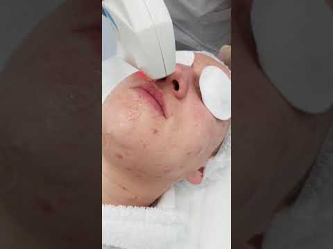 Видео: Elos-омоложение в клинике LazerJazz (Хамовнический вал, дом 36)