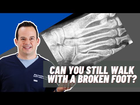 Видео: Можно ли ходить со сломанной ногой? | Доктор Ник Кампителли