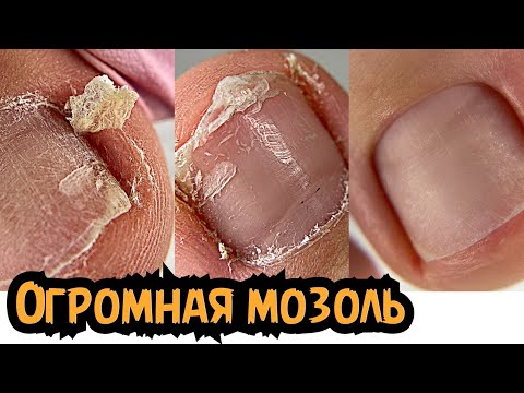 Видео: МОЙ ПОЗОР 😱 Огромная подногтевая мозоль / Болит палец / Педикюр на себе